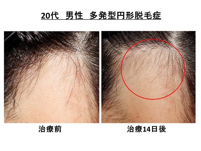 円形脱毛症　病院